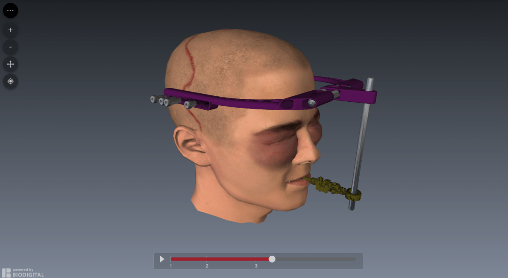 Le Fort III Surgery – myFace