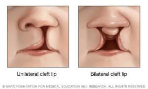 Unilateral cleft lip and bilateral cleft lip
