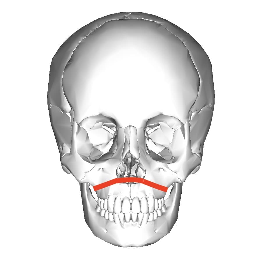 Le Fort I Guide: Procedure, Recovery, and More – myFace