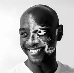 james-mcleod-headshot headshot of james mcleod, "the vitiligo guy"